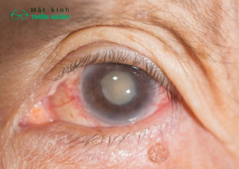 Các bệnh về mắt thường gặp ở người cao tuổi và cách khắc phục
